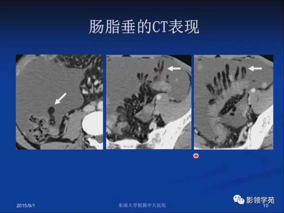 影像PPT - 【PPT】急性原发性肠脂垂炎影像诊断-10
