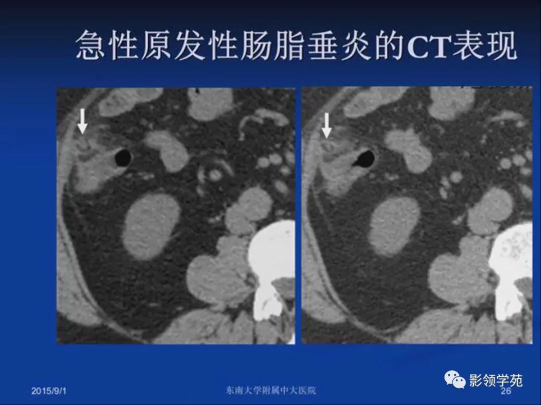 影像PPT - 【PPT】急性原发性肠脂垂炎影像诊断-26