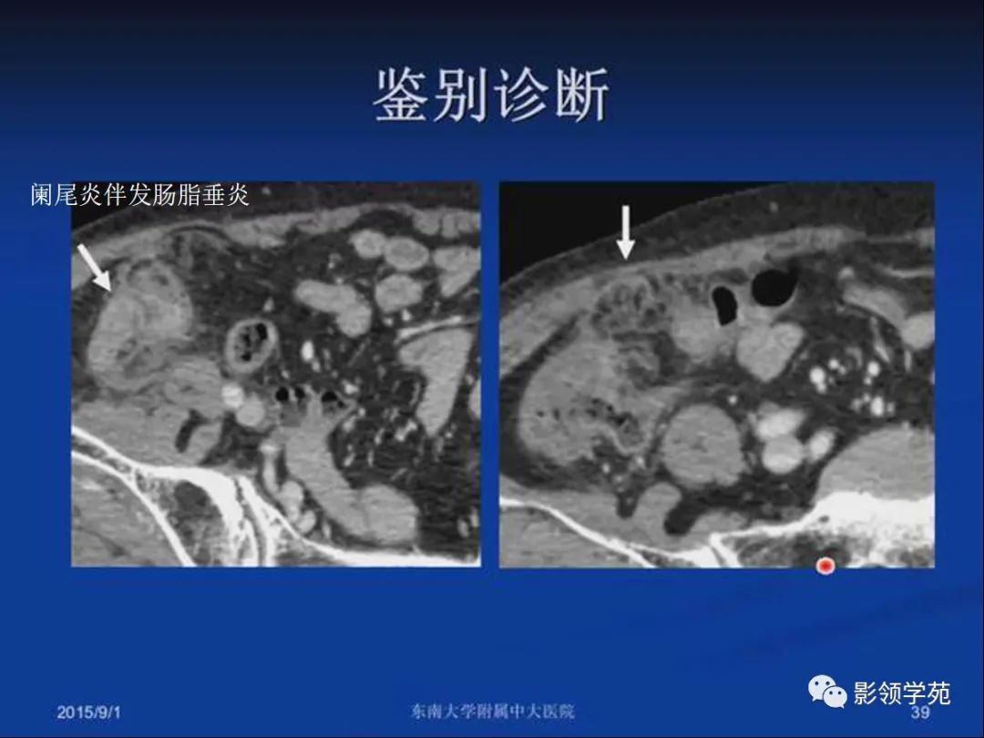 影像PPT - 【PPT】急性原发性肠脂垂炎影像诊断-39