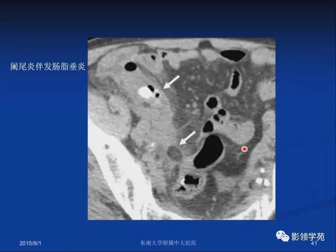 影像PPT - 【PPT】急性原发性肠脂垂炎影像诊断-41