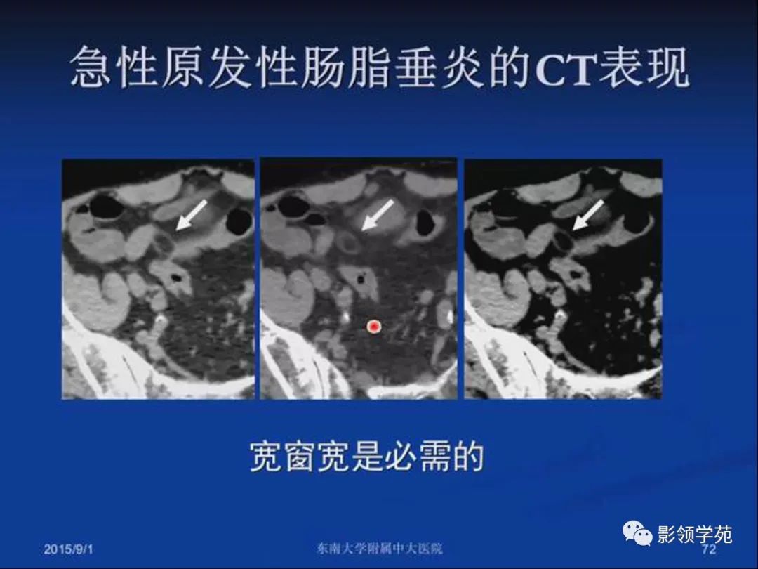 影像PPT - 【PPT】急性原发性肠脂垂炎影像诊断-71