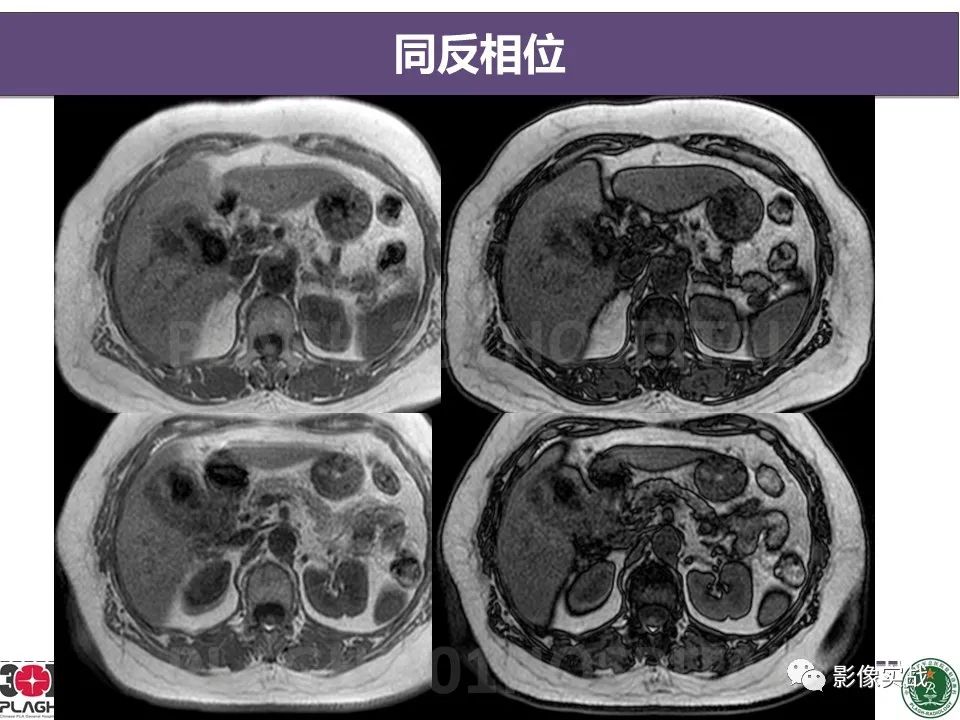 影像PPT - 【病例】化脓性胆囊炎1例CT及MR-8