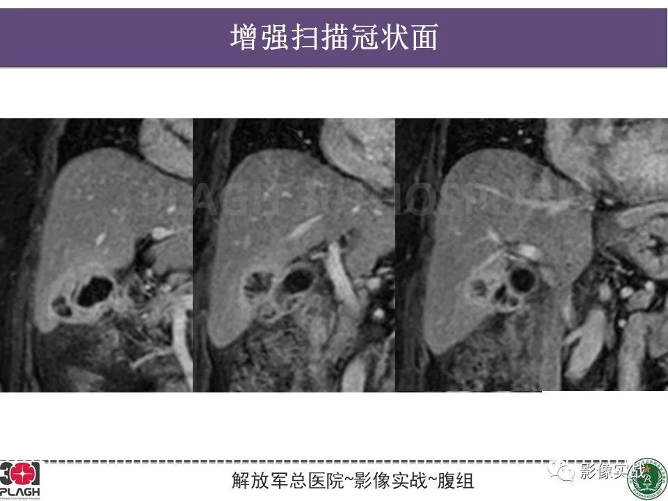 影像PPT - 【病例】化脓性胆囊炎1例CT及MR-11