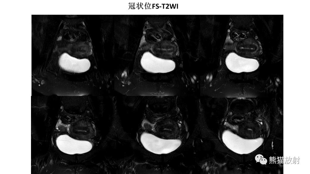 影像PPT - 【PPT】子宫内膜癌的影像分期表现-6
