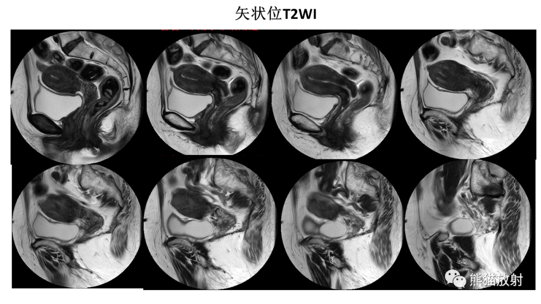 影像PPT - 【PPT】子宫内膜癌的影像分期表现-4