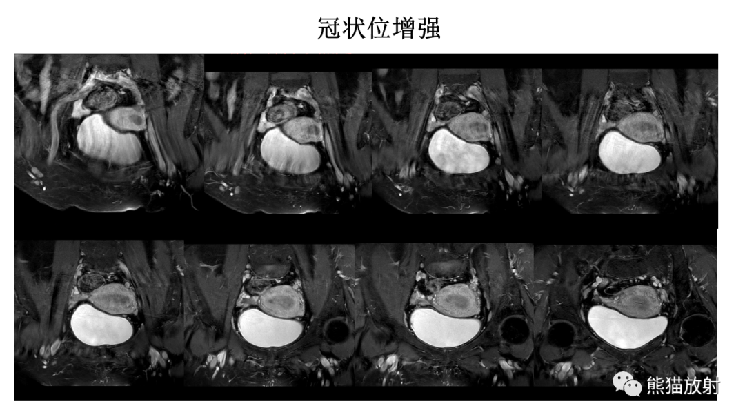 影像PPT - 【PPT】子宫内膜癌的影像分期表现-11