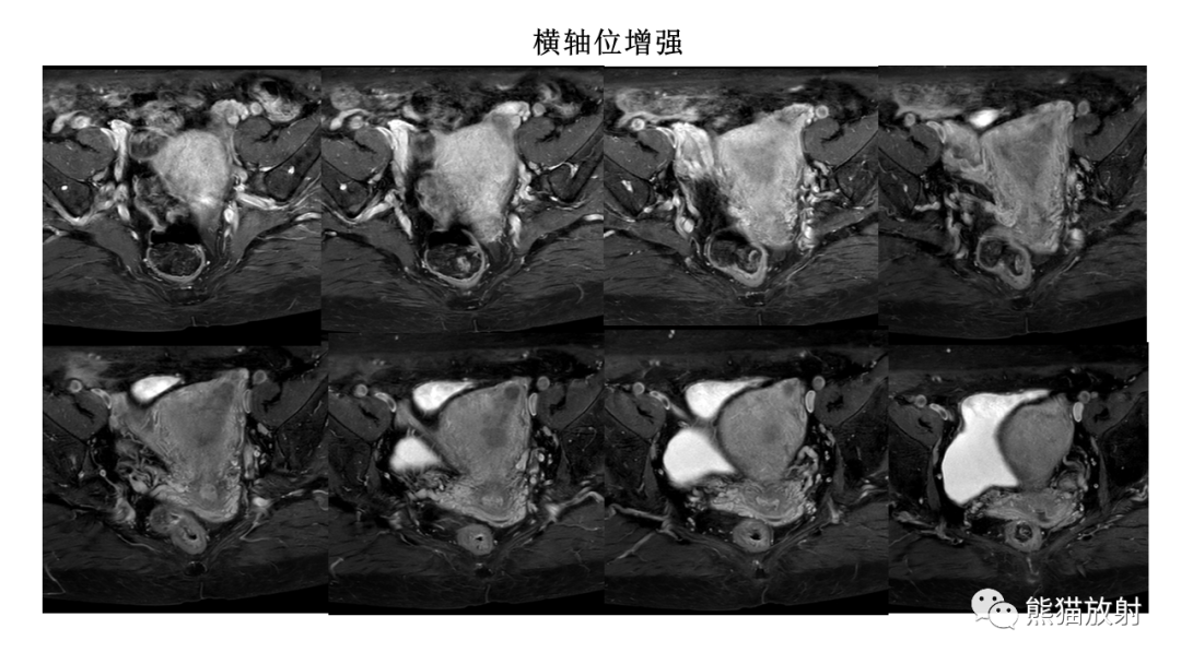 影像PPT - 【PPT】子宫内膜癌的影像分期表现-12