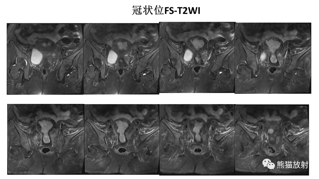 影像PPT - 【PPT】子宫内膜癌的影像分期表现-18