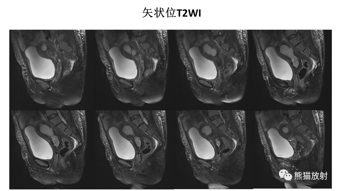 影像PPT - 【PPT】子宫内膜癌的影像分期表现-17