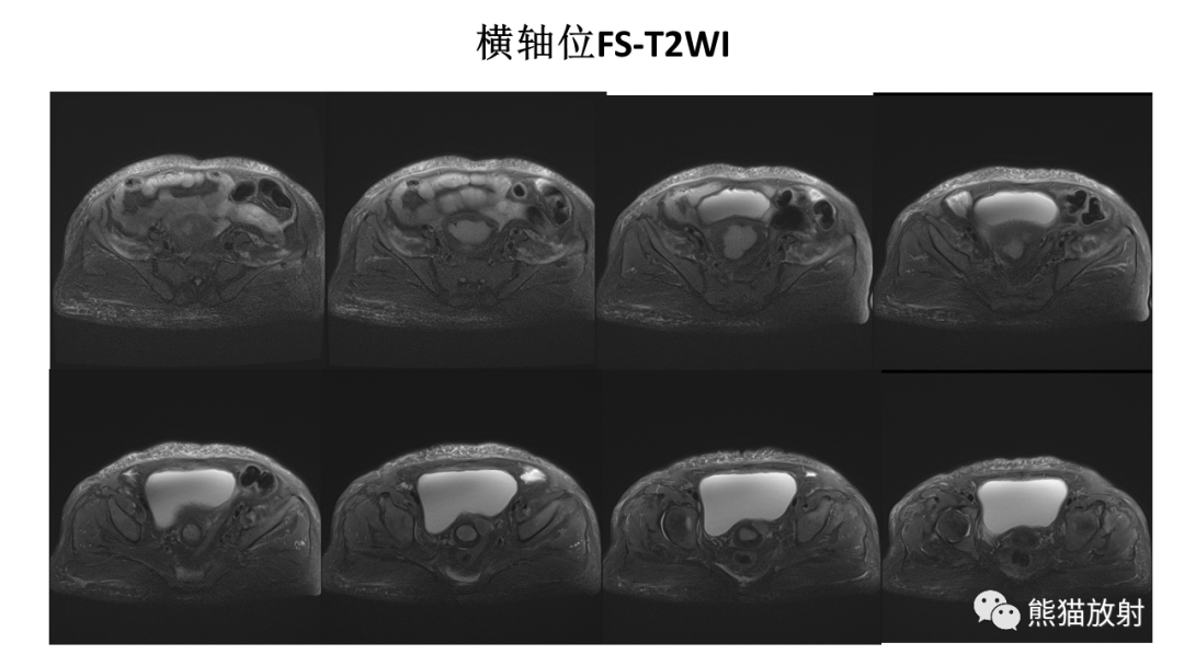 影像PPT - 【PPT】子宫内膜癌的影像分期表现-19