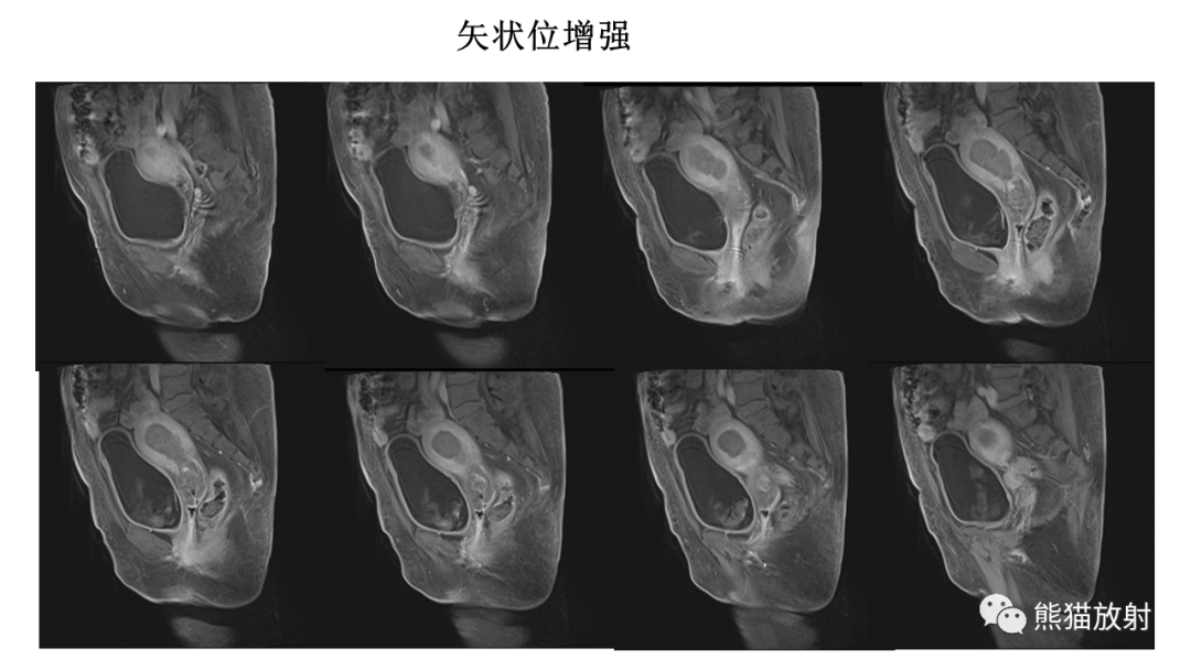 影像PPT - 【PPT】子宫内膜癌的影像分期表现-23