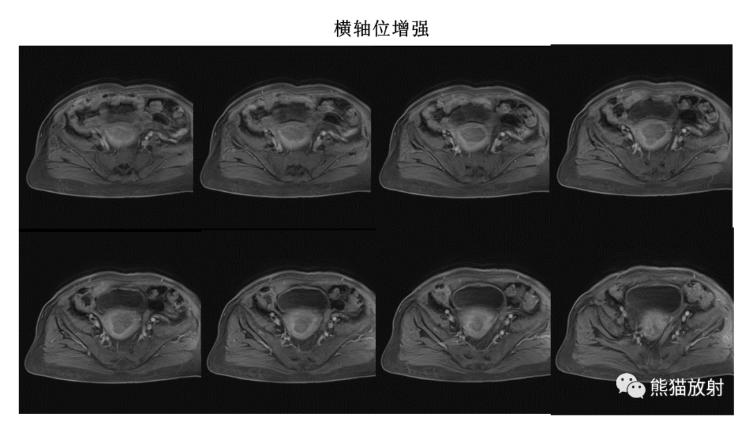 影像PPT - 【PPT】子宫内膜癌的影像分期表现-24