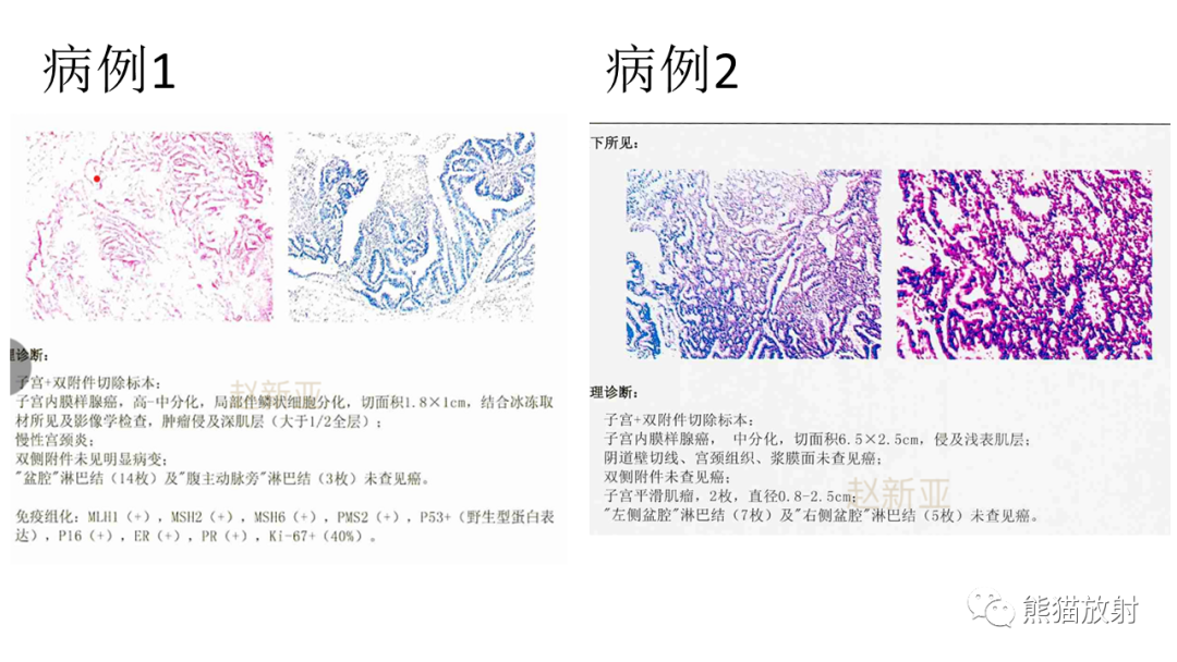 影像PPT - 【PPT】子宫内膜癌的影像分期表现-26
