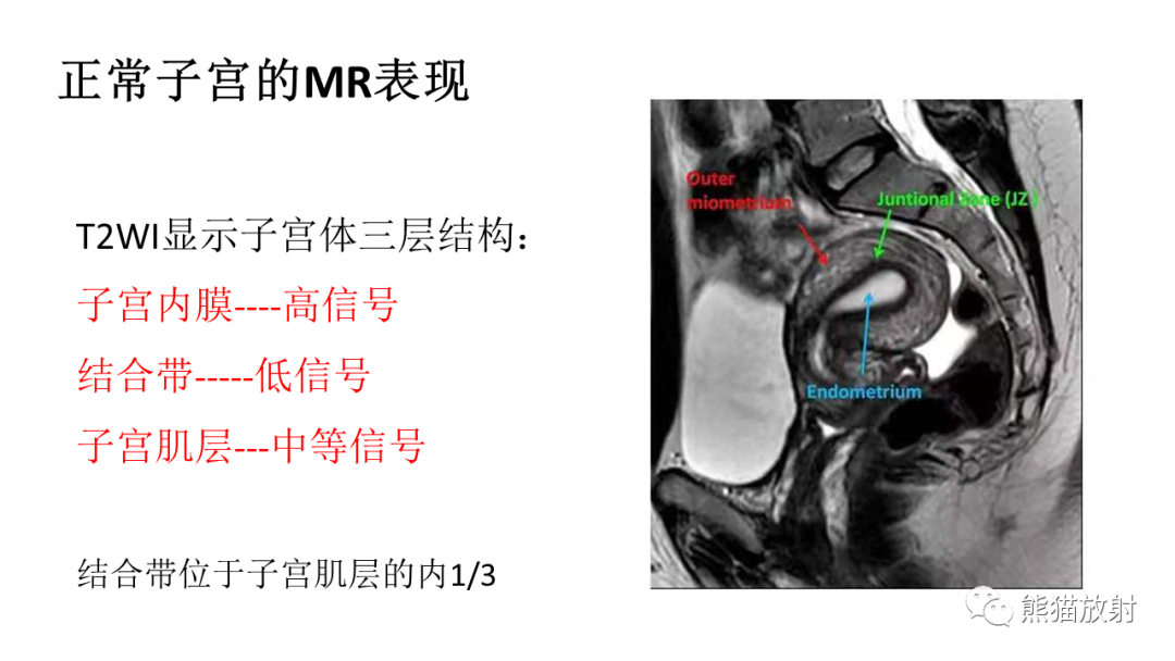 影像PPT - 【PPT】子宫内膜癌的影像分期表现-33