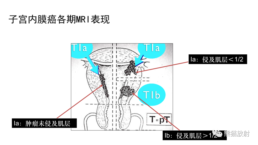 影像PPT - 【PPT】子宫内膜癌的影像分期表现-35