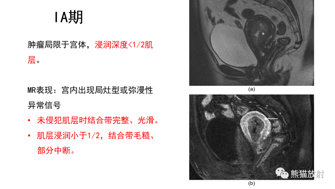 影像PPT - 【PPT】子宫内膜癌的影像分期表现-36