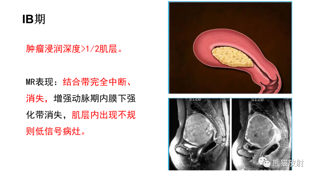 影像PPT - 【PPT】子宫内膜癌的影像分期表现-37