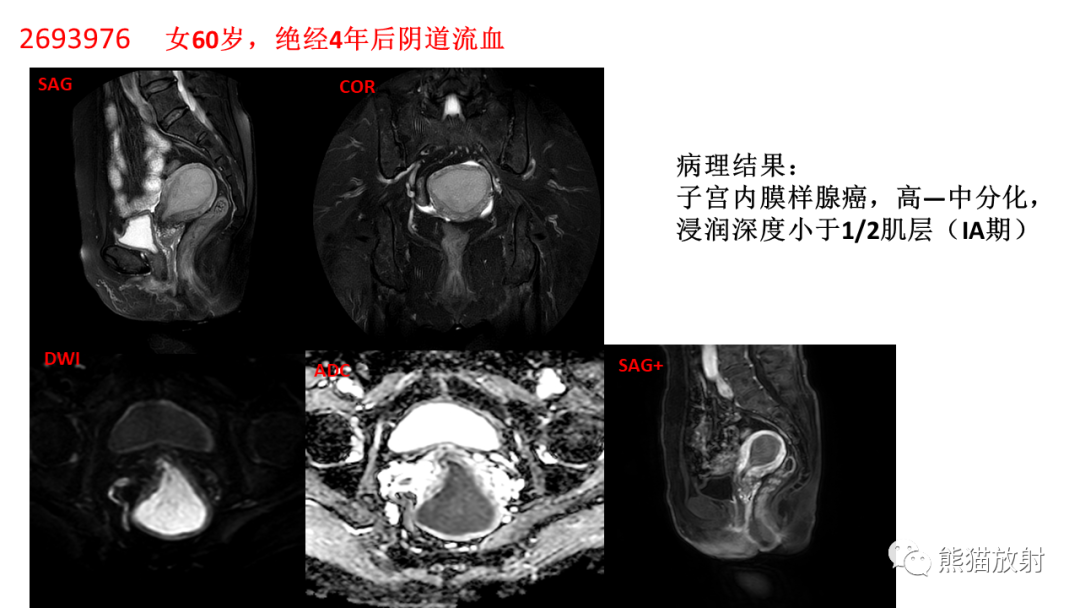 影像PPT - 【PPT】子宫内膜癌的影像分期表现-39
