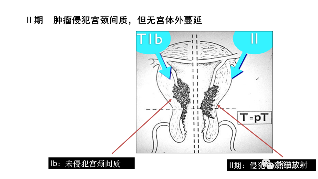 影像PPT - 【PPT】子宫内膜癌的影像分期表现-40