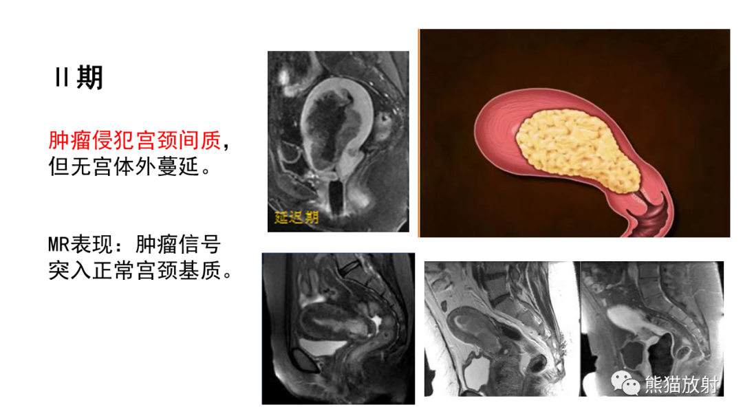 影像PPT - 【PPT】子宫内膜癌的影像分期表现-41