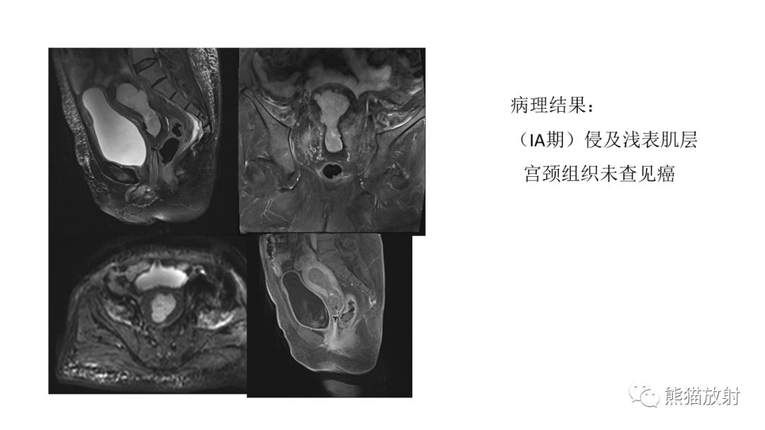 影像PPT - 【PPT】子宫内膜癌的影像分期表现-42