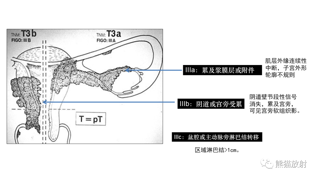 影像PPT - 【PPT】子宫内膜癌的影像分期表现-44