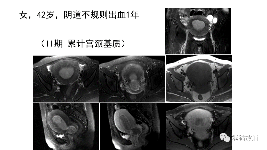 影像PPT - 【PPT】子宫内膜癌的影像分期表现-43