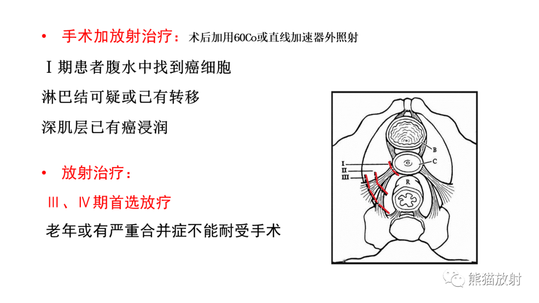 影像PPT - 【PPT】子宫内膜癌的影像分期表现-49