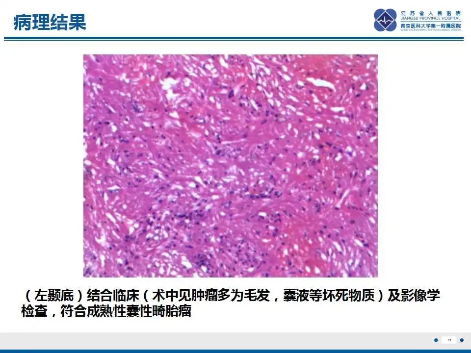 影像PPT - 【PPT】颅内畸胎瘤-13