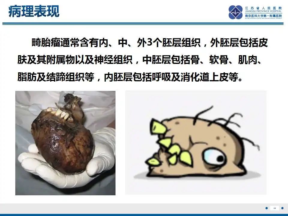 影像PPT - 【PPT】颅内畸胎瘤-23