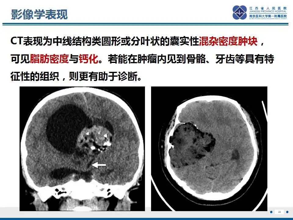 影像PPT - 【PPT】颅内畸胎瘤-25