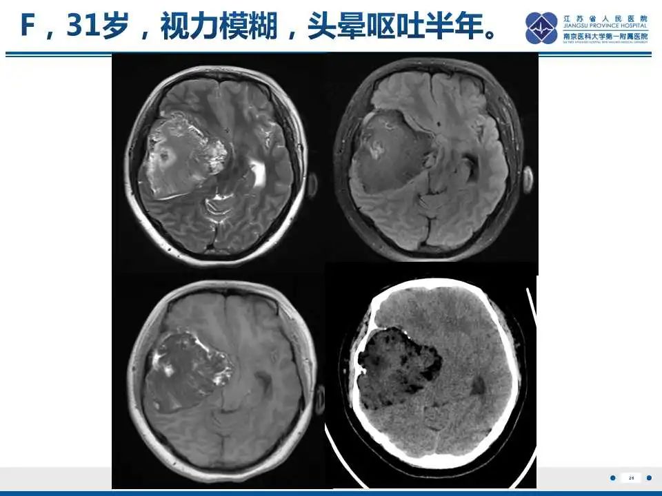 影像PPT - 【PPT】颅内畸胎瘤-27