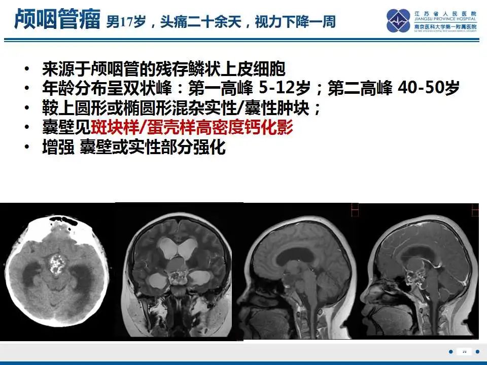 影像PPT - 【PPT】颅内畸胎瘤-30
