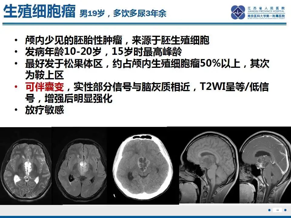 影像PPT - 【PPT】颅内畸胎瘤-31