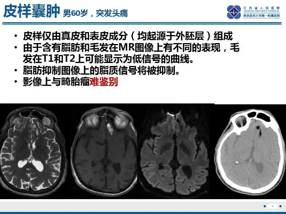 影像PPT - 【PPT】颅内畸胎瘤-32