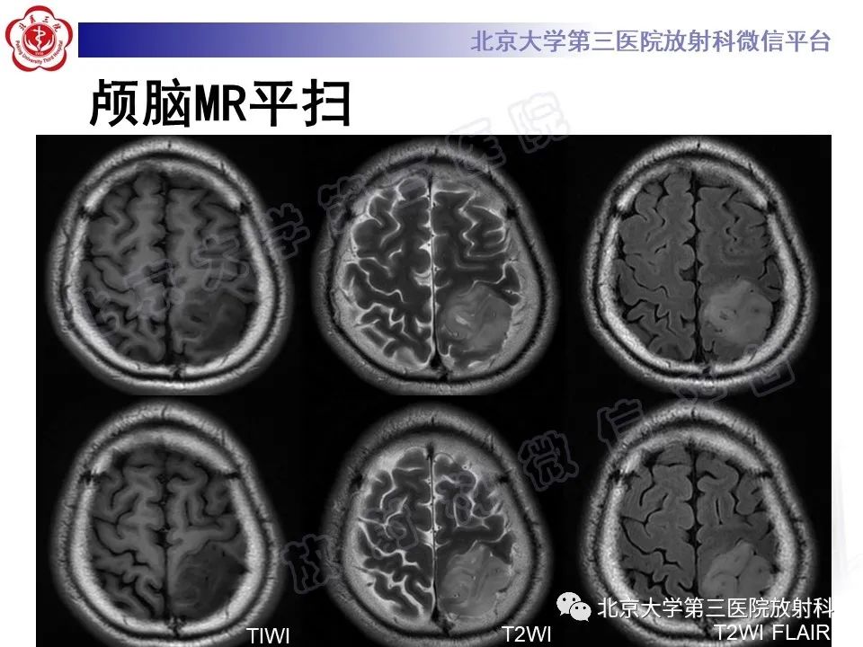 影像PPT - 【PPT】少突胶质细胞瘤-4