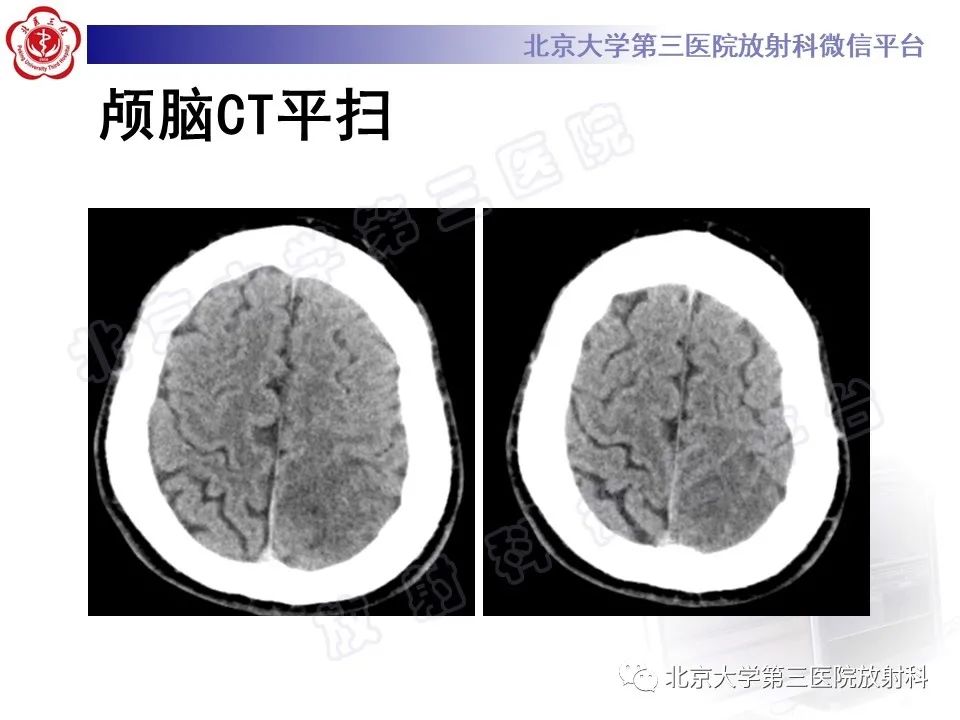 影像PPT - 【PPT】少突胶质细胞瘤-3