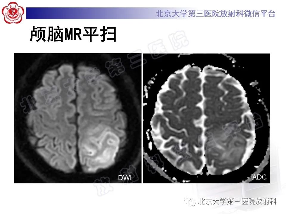 影像PPT - 【PPT】少突胶质细胞瘤-5