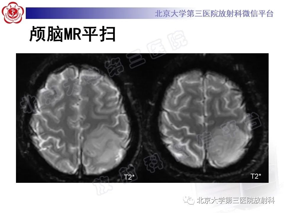 影像PPT - 【PPT】少突胶质细胞瘤-6