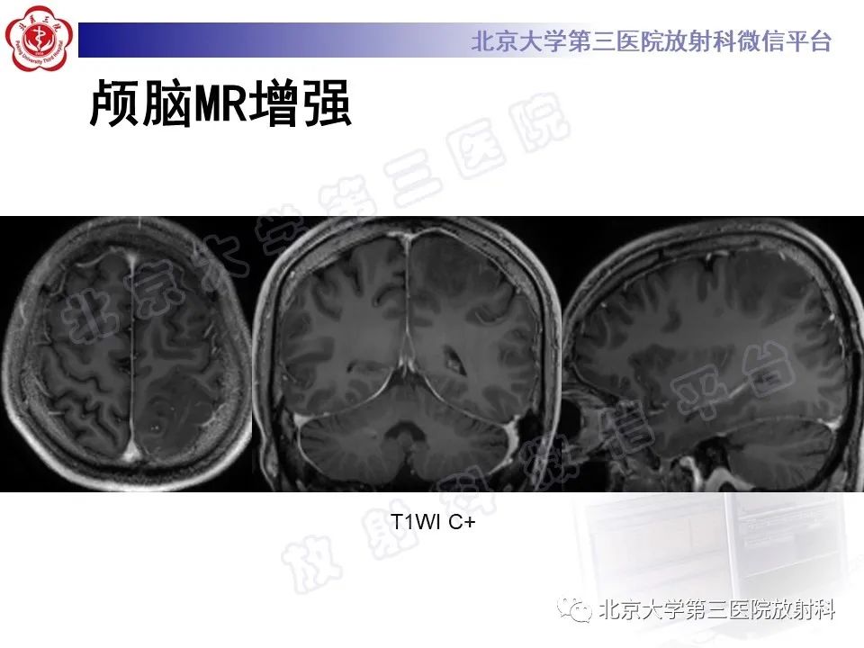 影像PPT - 【PPT】少突胶质细胞瘤-7