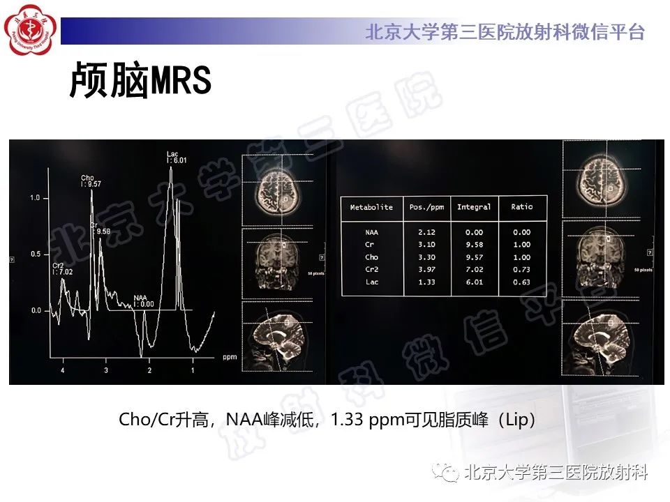 影像PPT - 【PPT】少突胶质细胞瘤-8