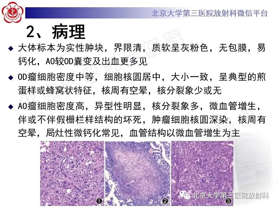 影像PPT - 【PPT】少突胶质细胞瘤-14