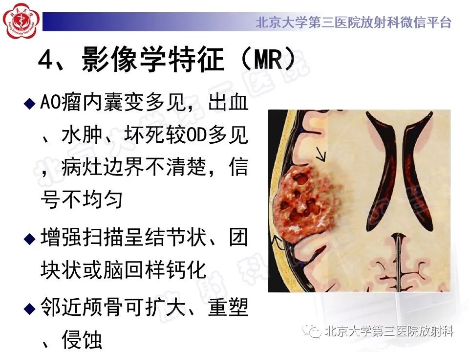 影像PPT - 【PPT】少突胶质细胞瘤-18