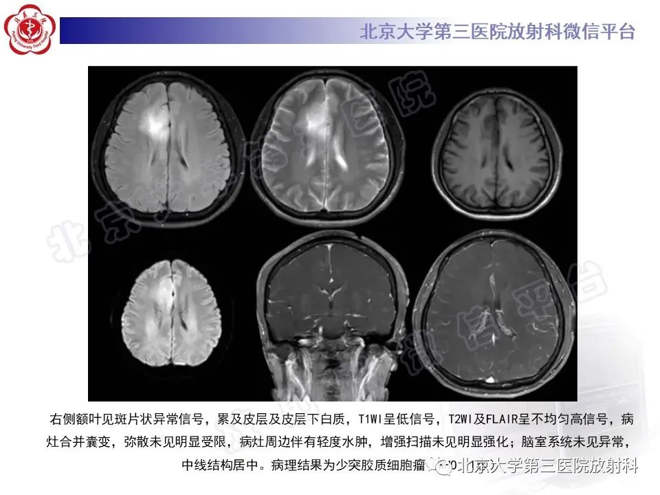 影像PPT - 【PPT】少突胶质细胞瘤-20