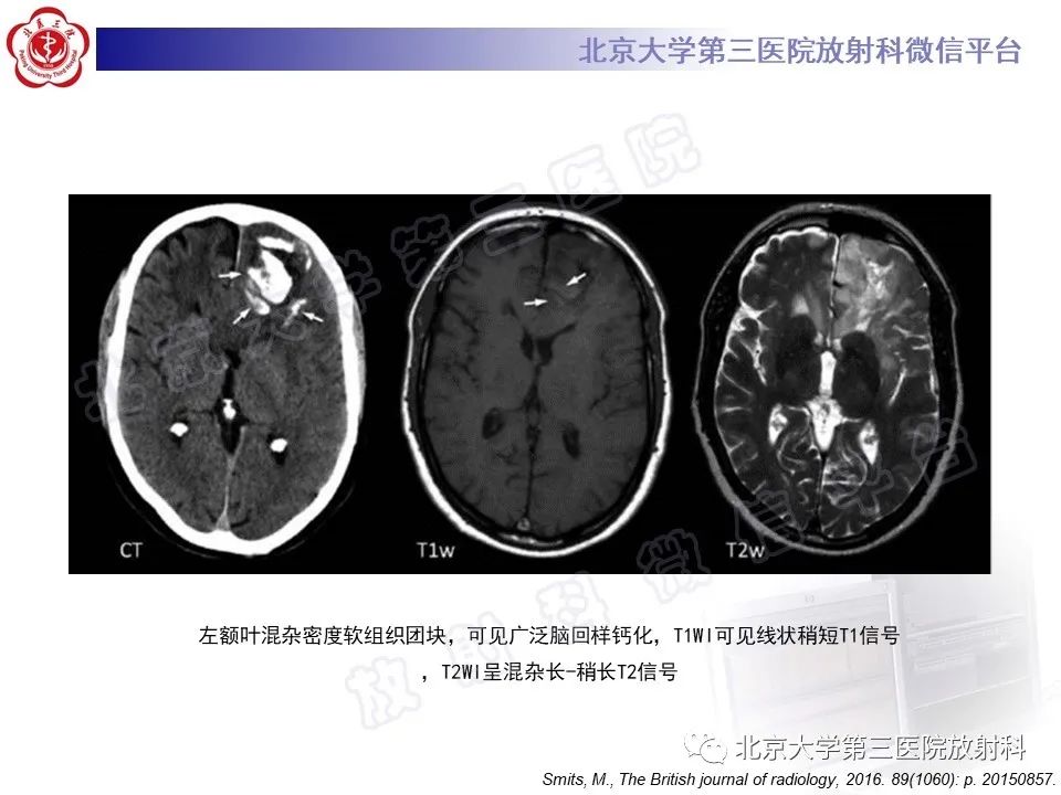 影像PPT - 【PPT】少突胶质细胞瘤-21