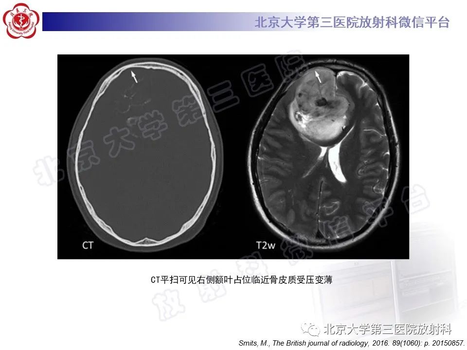 影像PPT - 【PPT】少突胶质细胞瘤-22