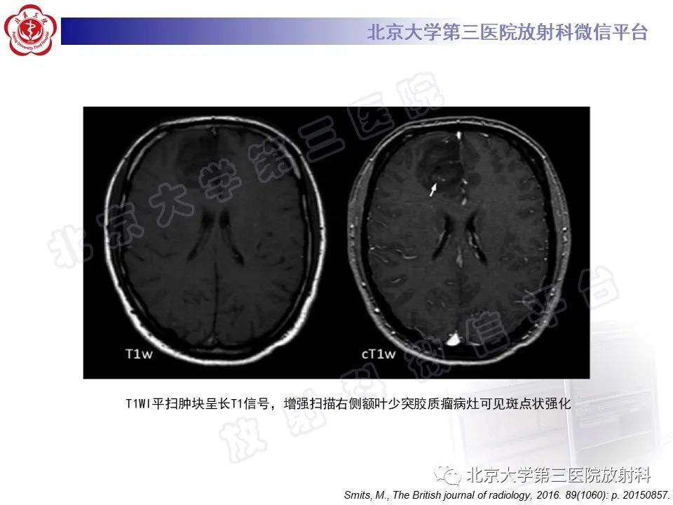 影像PPT - 【PPT】少突胶质细胞瘤-23