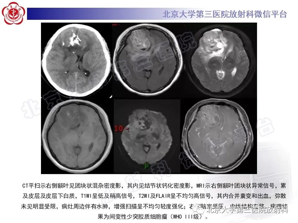 影像PPT - 【PPT】少突胶质细胞瘤-24