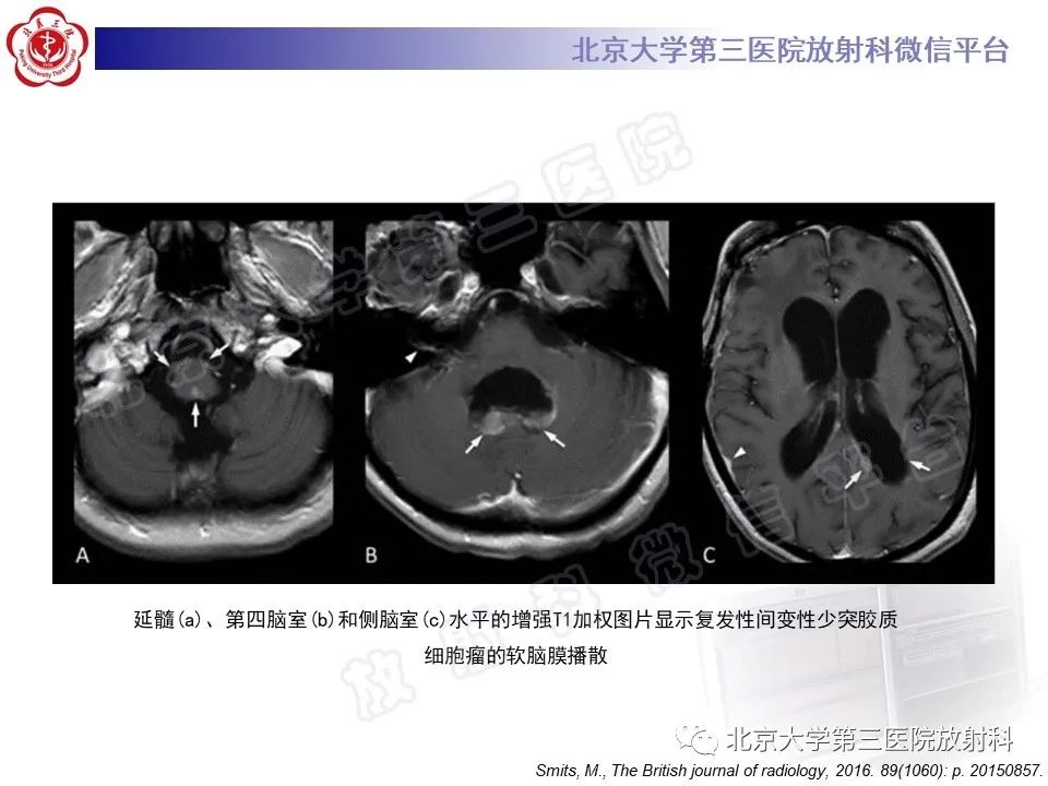 影像PPT - 【PPT】少突胶质细胞瘤-25