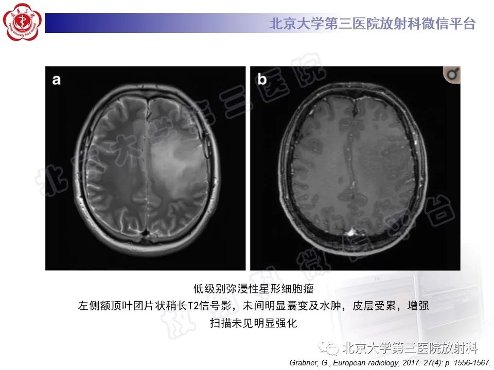 影像PPT - 【PPT】少突胶质细胞瘤-28